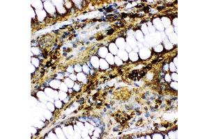 Anti-p73 antibody, (ABIN3043469), IHC(P)IHC(P): Human Intestinal Cancer Tissue (Tumor Protein p73 抗体  (AA 1-198))