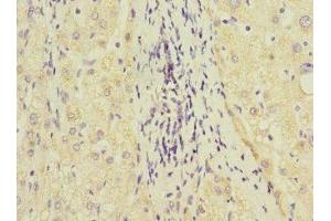 Immunohistochemistry of paraffin-embedded human liver cancer using ABIN7154098 at dilution of 1:100 (GSTK1 抗体  (AA 1-226))