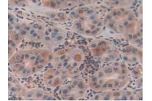 Detection of CLIC1 in Human Liver Cancer Tissue using Polyclonal Antibody to Chloride Intracellular Channel Protein 1 (CLIC1) (CLIC1 抗体  (AA 79-241))