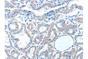 The image on the left is immunohistochemistry of paraffin-embedded Human thyroid cancer tissue using ABIN7128233(ADAM21 Antibody) at dilution 1/15, on the right is treated with fusion protein. (ADAM21 抗体)