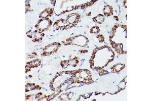 Immunohistochemistry of paraffin-embedded human thyroid cancer using L1 Rabbit pAb (ABIN6134555, ABIN6137248, ABIN6137250 and ABIN6215529) at dilution of 1:100 (40x lens). (ATG16L1 抗体  (AA 200-300))