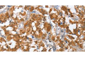 Immunohistochemistry of paraffin-embedded Human thyroid cancer using TP53BP2 Polyclonal Antibody at dilution of 1:35 (TP53BP2 抗体)