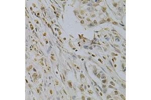 Immunohistochemistry of paraffin-embedded human gastric cancer using SUMO1 Antibody (ABIN5971157) at dilution of 1/200 (40x lens). (SUMO1 抗体)
