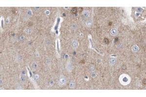 ABIN6278481 at 1/100 staining Human brain cancer tissue by IHC-P. (IL20RA 抗体  (C-Term))