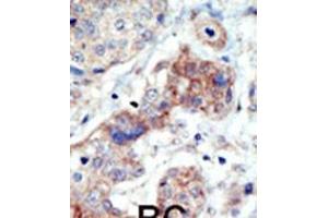 Formalin-fixed and paraffin-embedded human cancer tissue reacted with the primary antibody, which was peroxidase-conjugated to the secondary antibody, followed by DAB staining. (EPH Receptor B3 抗体  (N-Term))