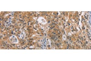 Immunohistochemistry of paraffin-embedded Human gastric cancer tissue using ZADH2 Polyclonal Antibody at dilution of 1:100(x200) (ZADH2 抗体)
