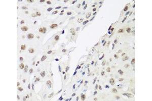 Immunohistochemistry of paraffin-embedded Human lung cancer using CBX3 Polyclonal Antibody at dilution of 1:200 (40x lens). (CBX3 抗体)