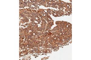 Immunohistochemical analysis of paraffin-embedded Human colon carcinoma tissue using (ABIN656331 and ABIN2845630) performed on the Leica® BOND RXm. (SLC16A3 抗体  (C-Term))