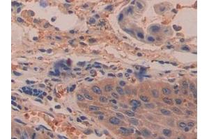 Detection of DDAH2 in Human Stomach cancer Tissue using Polyclonal Antibody to Dimethylarginine Dimethylaminohydrolase 2 (DDAH2) (DDAH2 抗体  (AA 31-265))