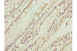 Immunohistochemistry of paraffin-embedded human colon cancer using ABIN7173269 at dilution of 1:100 (TMEM71 抗体  (AA 1-210))