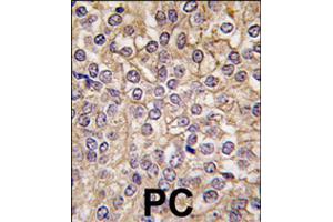 Formalin-fixed and paraffin-embedded human prostate carcinoma tissue reacted with IL1R1 polyclonal antibody  , which was peroxidase-conjugated to the secondary antibody, followed by DAB staining . (IL1RL2 抗体  (C-Term))