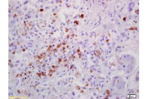 Formalin-fixed and paraffin embedded human lung carcinoma labeled with Anti-IL-7 Polyclonal Antibody, Unconjugated (ABIN734783) at 1:200 followed by conjugation to the secondary antibody and DAB staining (IL-7 抗体  (AA 51-154))