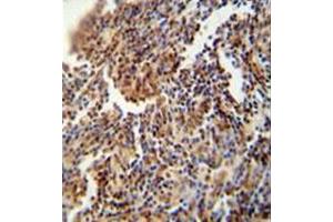 Immunohistochemistry analysis in formalin fixed and paraffin embedded human lung carcinoma reacted with HFM1 Antibody (C-term) followed which was peroxidase conjugated to the secondary antibody and followed by DAB staining. (HFM1 抗体  (C-Term))