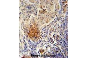 TYROBP Antibody (C-term) immunohistochemistry analysis in formalin fixed and paraffin embedded human lung carcinoma followed by peroxidase conjugation of the secondary antibody and DAB staining. (TYROBP 抗体  (C-Term))