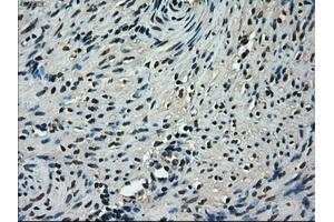 Immunohistochemical staining of paraffin-embedded Adenocarcinoma of ovary tissue using anti-TMEM100mouse monoclonal antibody. (TMEM100 抗体)