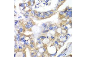 Immunohistochemistry of paraffin-embedded human liver cancer using PNLIP antibody (ABIN5975718) at dilution of 1/100 (40x lens). (PNLIP 抗体)