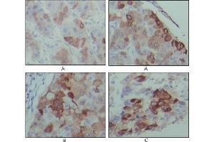 Immunohistochemical analysis of paraffin-embedded human hepatocarcinoma (A), breast carcinoma (B) and lung cancer tissues (C), showing cytoplasmic localization with DAB staining using PEG10 antibody. (PEG10 抗体)