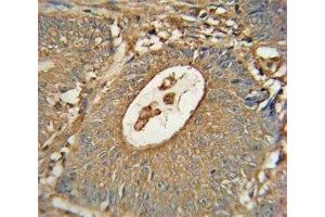 ACOX1 antibody immunohistochemistry analysis in formalin fixed and paraffin embedded human colon carcinoma (ACOX1 抗体)