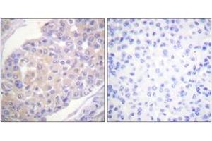 Immunohistochemistry analysis of paraffin-embedded human breast carcinoma, using p130 Cas (Phospho-Tyr165) Antibody. (BCAR1 抗体  (pTyr165))
