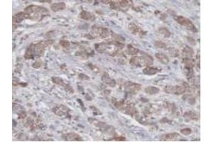 Detection of UBE2L3 in Human Breast Cancer Tissue using Polyclonal Antibody to Ubiquitin Conjugating Enzyme E2L3 (UBE2L3) (UBE2L3 抗体  (AA 4-154))