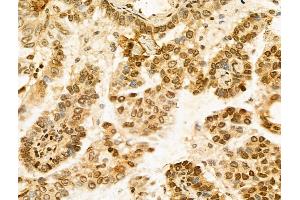 ABIN7094276 and ABIN7098323 at 1/100 staining Human lung cancer by IHC-P. (Histone Cluster 1, H1t (HIST1H1T) (Internal Region) 抗体)