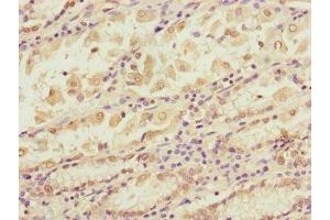 Immunohistochemistry of paraffin-embedded human gastric cancer using ABIN7145604 at dilution of 1:100 (BLOC1S2 抗体  (AA 44-142))