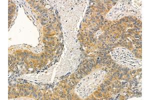 IREB1 Mouse Monoclonal Antibody at 1/100 staining human lung cancer and adjacent non-tumor tissue by IHC-P. (Aconitase 1 抗体)
