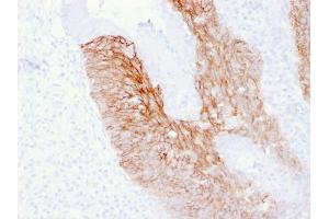 Formalin-fixed, paraffin-embedded human Cervix Carcinoma stained with CD44v6 Mouse Monoclonal Antibody (2F10).