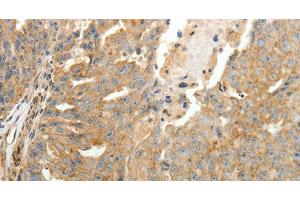 Immunohistochemistry of paraffin-embedded Human ovarian cancer tissue using SFTPD Polyclonal Antibody at dilution 1:30 (SFTPD 抗体)