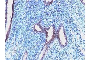 Formalin-fixed, paraffin-embedded human endometrial carcinoma stained with Cyclin B1 antibody (CCNB1/1098).