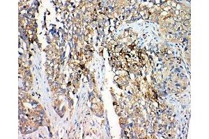 IHC-P: 17-beta-Hydroxysteroid dehydrogenase 4 antibody testing of human lung cancer tissue (HSD17B4 抗体  (C-Term))