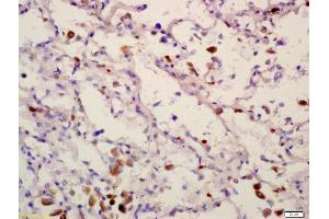 Formalin-fixed and paraffin embedded human lung carcinoma labeled with Anti-PPM1D Polyclonal Antibody, Unconjugated (ABIN740415) at 1:200 followed by conjugation to the secondary antibody and DAB staining (PPM1D 抗体  (AA 201-300))