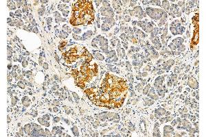 ABIN6264314 and ABIN6274038 at 1/100 staining Human pancreatic cancer and adjacent nomal tissues by IHC-P.