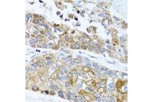 Immunohistochemistry of paraffin-embedded human lung cancer using PEX14 antibody. (PEX14 抗体  (AA 118-377))