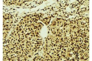 ABIN6274516 at 1/100 staining Human breast cancer tissue by IHC-P. (ZNF287 抗体)