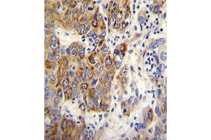 CYP2B6 Antibody immunohistochemistry analysis in formalin fixed and paraffin embedded human hepatocarcinoma followed by peroxidase conjugation of the secondary antibody and DAB staining. (CYP2B6 抗体  (AA 235-263))