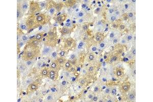 Immunohistochemistry of paraffin-embedded Human liver damage using Desmoplakin Polyclonal Antibody at dilution of 1:100 (40x lens). (Desmoplakin 抗体)