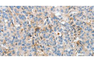 Immunohistochemistry of paraffin-embedded Human esophagus cancer using APOH Polyclonal Antibody at dilution of 1:30 (APOH 抗体)