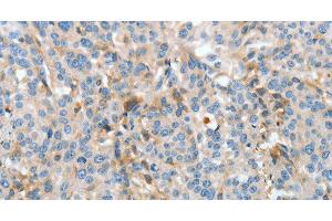 Immunohistochemistry of paraffin-embedded Human esophagus cancer using APOH Polyclonal Antibody at dilution of 1:30