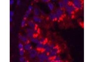 Immunofluorescence analysis of Human lung cancer tissue using CD68 Monoclonal Antibody at dilution of 1:200. (CD68 抗体)