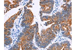 The image on the left is immunohistochemistry of paraffin-embedded Human colon cancer tissue using ABIN7130460(NR4A2 Antibody) at dilution 1/20, on the right is treated with fusion protein. (NR4A2 抗体)