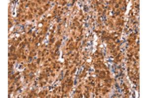 The image on the left is immunohistochemistry of paraffin-embedded Human gastic cancer tissue using ABIN7191185(KCNJ6 Antibody) at dilution 1/20, on the right is treated with synthetic peptide. (KCNJ6 抗体)