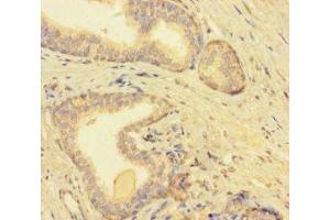 Immunohistochemistry of paraffin-embedded human prostate cancer using ABIN7173233 at dilution of 1:100 (TMEM52B 抗体  (AA 61-183))