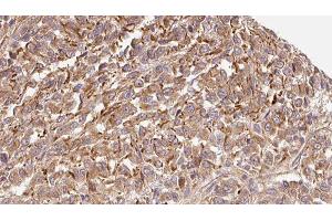 ABIN6279337 at 1/100 staining Human Melanoma tissue by IHC-P. (CST7 抗体  (N-Term))