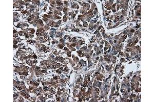 Immunohistochemical staining of paraffin-embedded Carcinoma of liver tissue using anti-BHMT mouse monoclonal antibody. (BHMT 抗体)