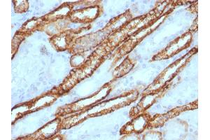 Formalin-fixed, paraffin-embedded human Renal Cell Carcinoma stained with KSP-Cadherin Rabbit Polyclonal Antibody. (Cadherin-16 抗体)