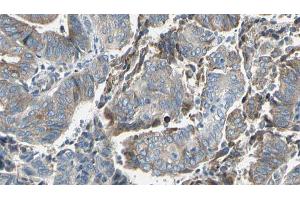 ABIN6273629 at 1/100 staining Human cervical cancer tissue by IHC-P. (GBP2 抗体  (Internal Region))