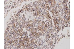 Immunohistochemical staining of paraffin-embedded Lung CA using Flotillin 2 antibody at a dilution of 1:100 (Flotillin 2 抗体)