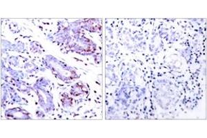 Immunohistochemistry analysis of paraffin-embedded human breast carcinoma tissue, using STAT1 (Ab-701) Antibody. (STAT1 抗体  (AA 668-717))