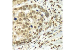 Immunohistochemistry of paraffin-embedded human esophageal cancer using HDAC2 antibody. (HDAC2 抗体  (C-Term))